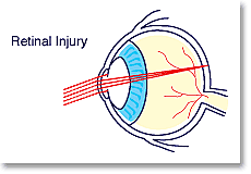 laser_injury_retinal